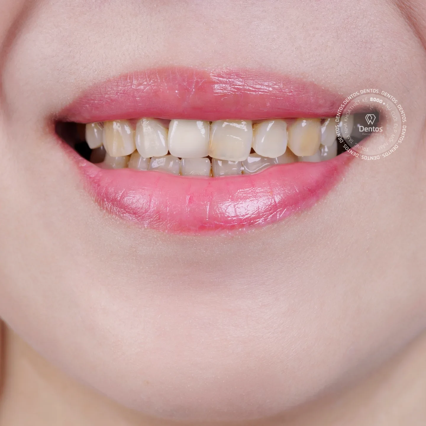 Răng bị xỉn màu, ố vàng có thể bọc răng sứ thẩm mỹ